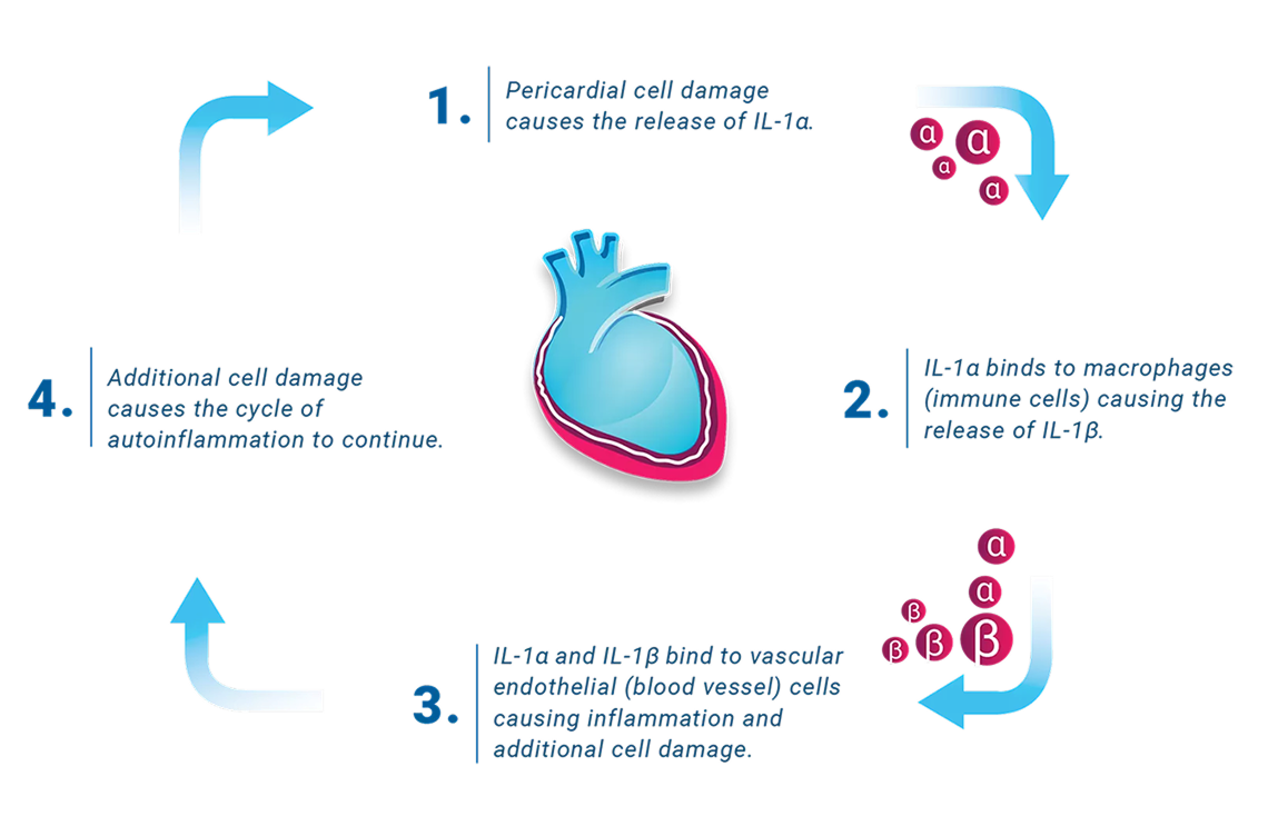 The Cycle of Autoinflammation in Recurrent Pericarditis: 1. Pericardial cell damage causes the release of IL-1α, 2. IL-1α binds to macrophages (immune cells) causing the release of IL-1β, 3.IL-1α and IL-1β bind to vascular endothelial (blood vessel) cells causing inflammation and additional cell damage, 4. Additional cell damage causes the cycle of autoinflammation to continue.